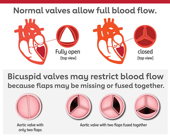 Ayurvedic Treatment For Heart Valve Stenosis